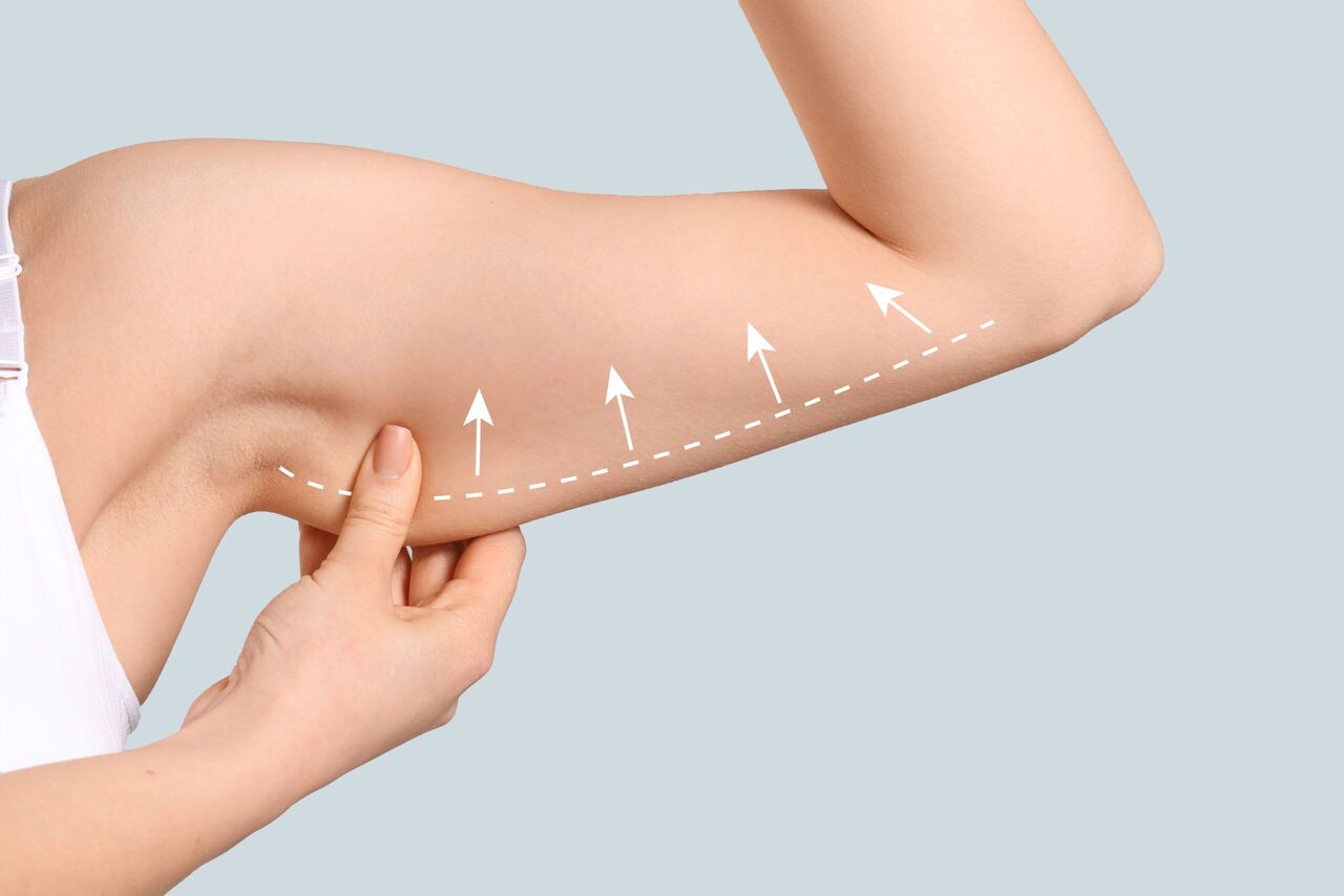 Arm Lift Surgery Results