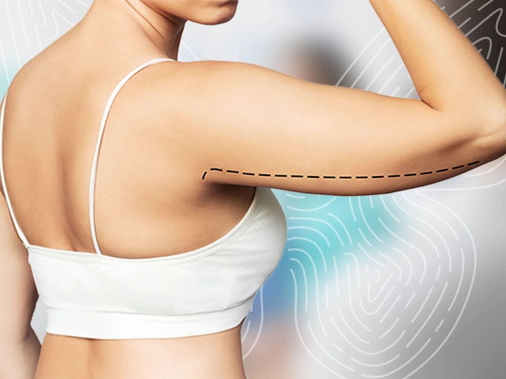 Arm Lift Surgery in Turkey