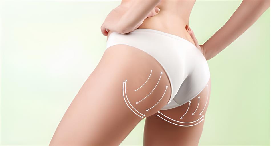 Brazilian Butt Lift in Turkey