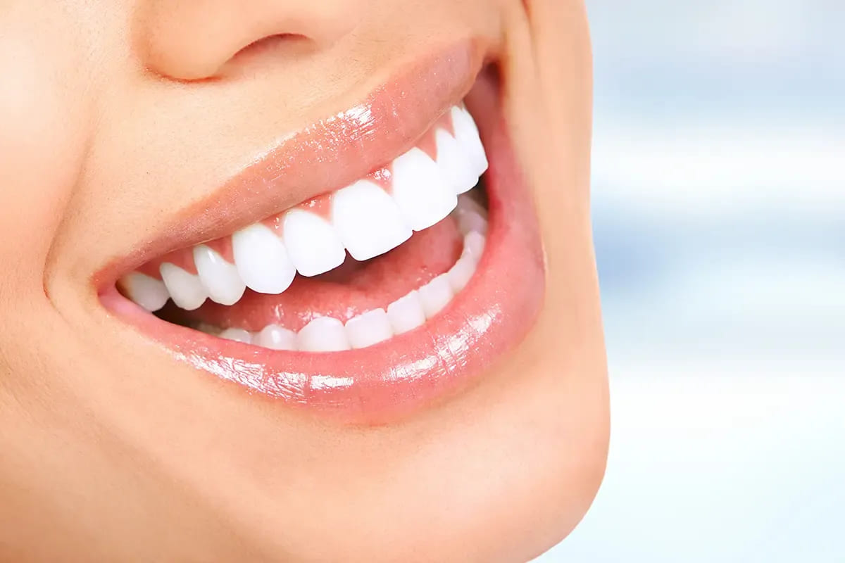 Laminate Veneers