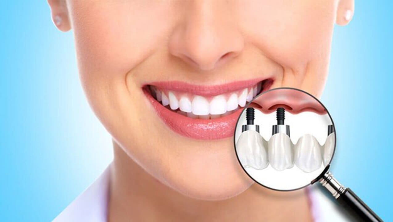 Dental Implants
