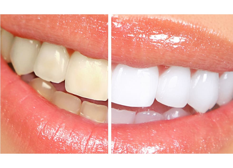 Teeth Whitening in Turkey