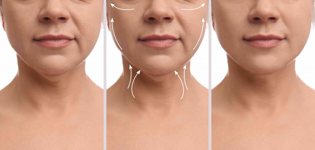 Face and Neck Lifting in Turkey