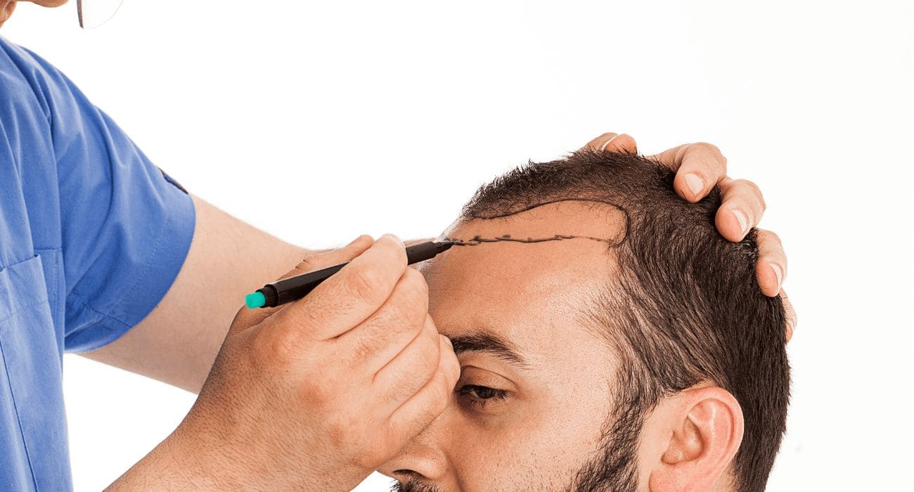 Eyebrow Transplant