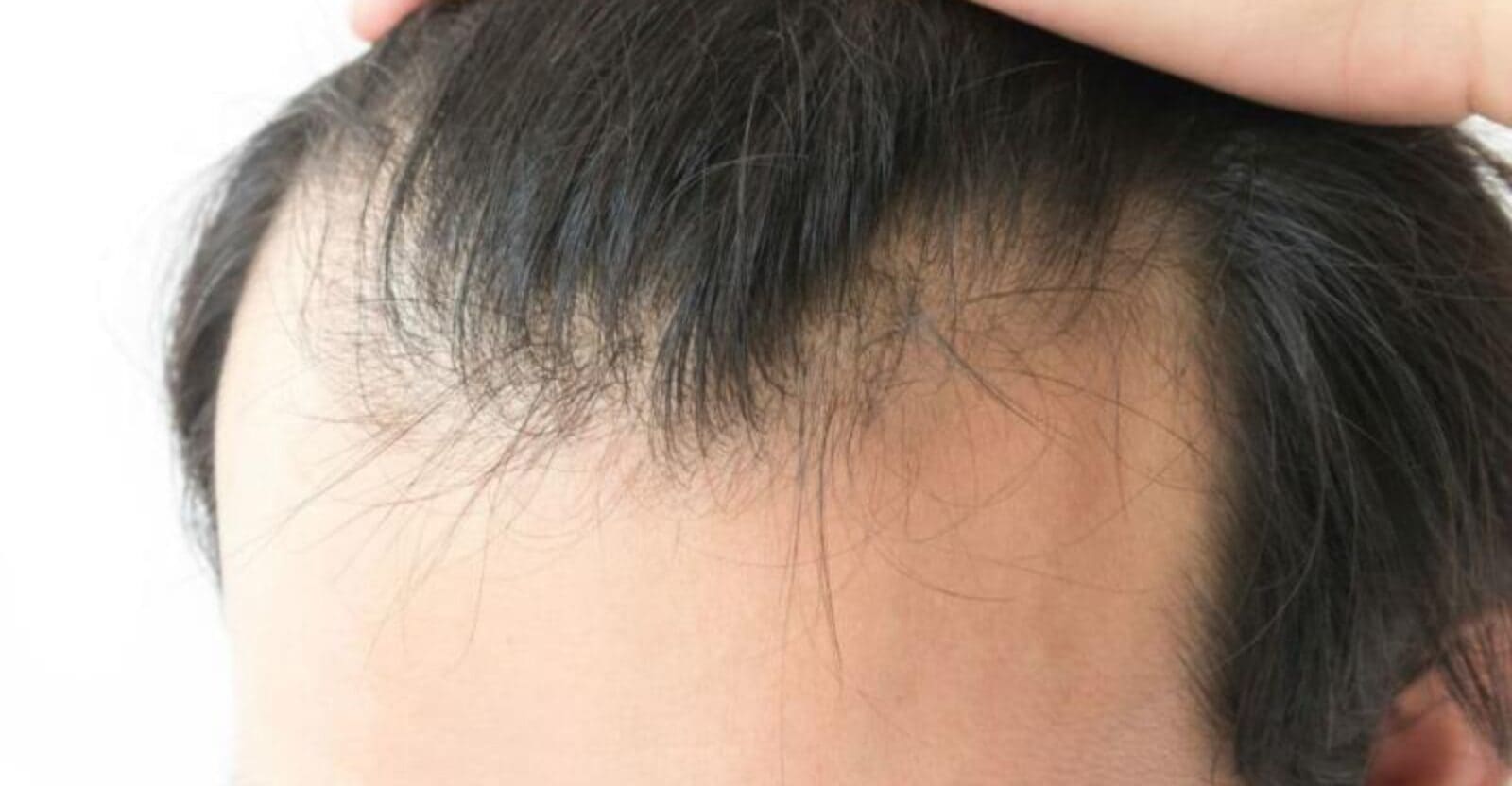 Direct Hair Implantation DHI