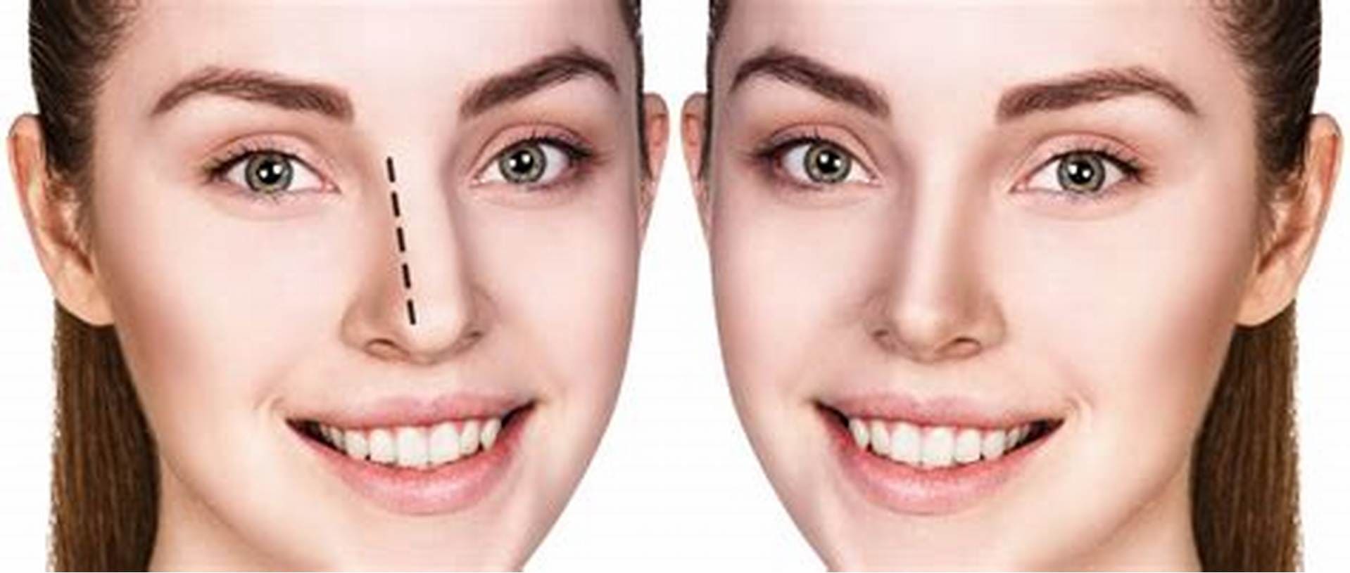 Rhinoplasty