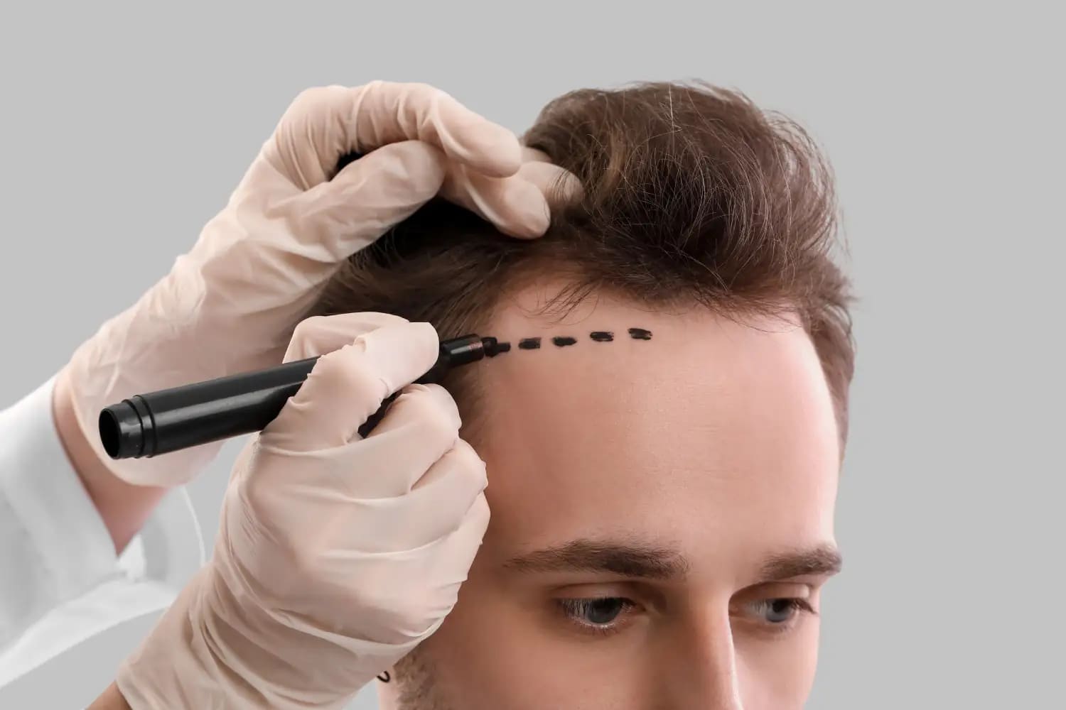 Tailored Hair Transplant