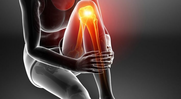 Knee Replacement